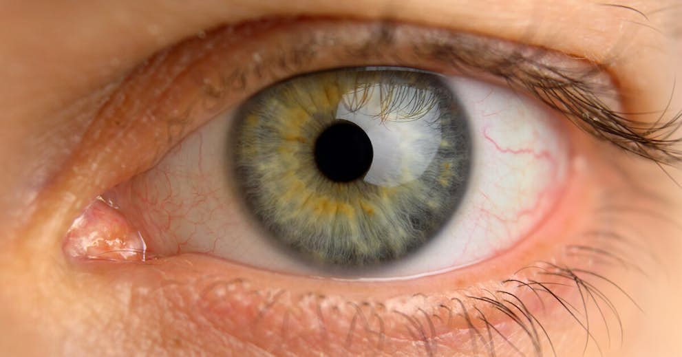 When Your Eyes Can Reveal If You Have Heart Disease… about false
